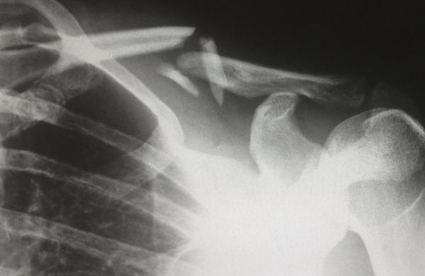 x-ray of a fractured clavicle