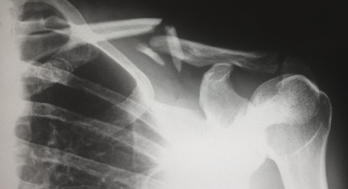 x-ray of a fractured clavicle